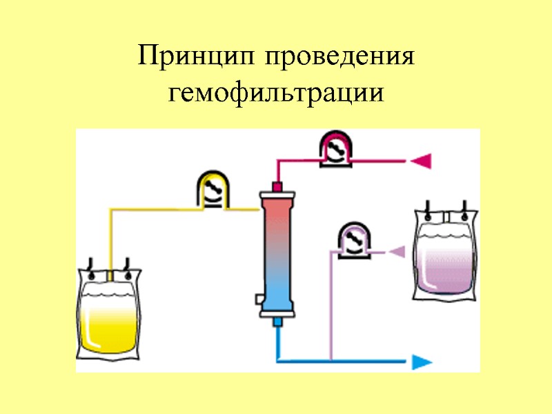 Принцип проведения гемофильтрации